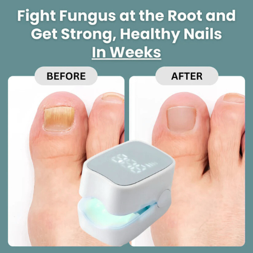 Vindora™ - Nail Fungus Laser Device