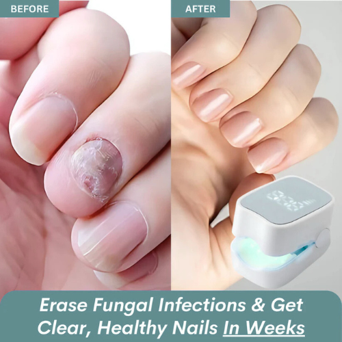 Vindora™ - Nail Fungus Laser Device