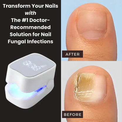 Vindora™ - Nail Fungus Laser Device